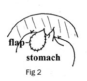 Circumcostal Gastropexy