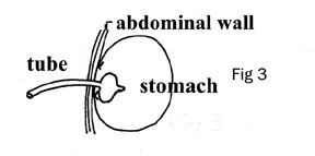 Tube Gastrotomy 